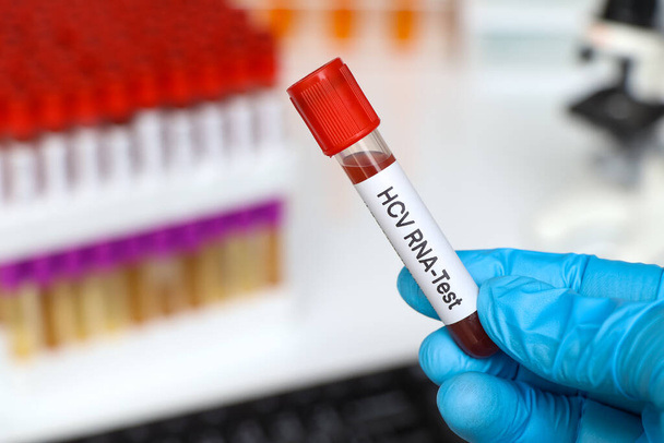 HCV-RNA-Test auf Auffälligkeiten im Blut, Blutprobe zur Analyse im Labor, Blut im Reagenzglas - Foto, Bild