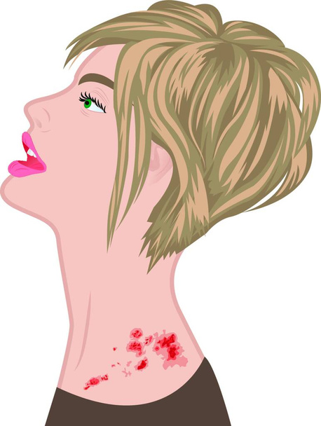 Shingles on a woman shoulder.   varicella zoster   vector illustration - Vector, Image