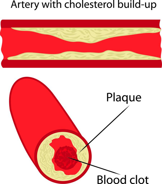 "Placa de colesterol en la arteria" - Vector, imagen