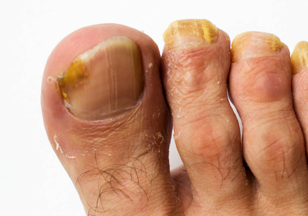 Gros plan champignon sur les ongles d'un homme pied sur un fond blanc - Photo, image