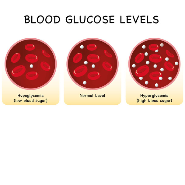Глюкоза в кровеносных сосудах. нормальный уровень, гипергликемия (высокий уровень сахара в крови), гипогликемия (низкий уровень сахара в крови). Векторная иллюстрация - Вектор,изображение