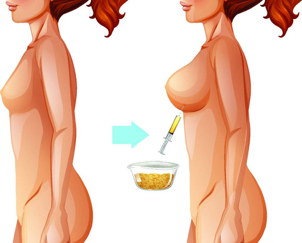 "Breast augmentation fat transfer method" - Vektor, kép