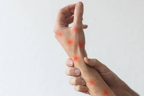 人々は手でかゆみを掻く。アレルギー性発疹皮膚炎患者の湿疹皮膚. - 写真・画像
