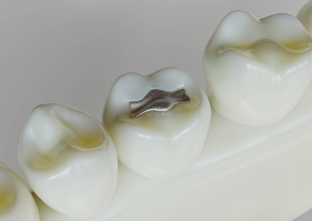 Restauración de amalgamas en un diente - 3D Rendering - Foto, Imagen