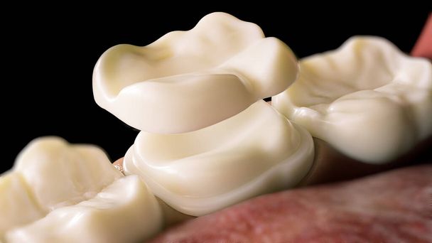 Coroa cerâmica sobreposição sobre uma renderização 3D de dentes - Foto, Imagem