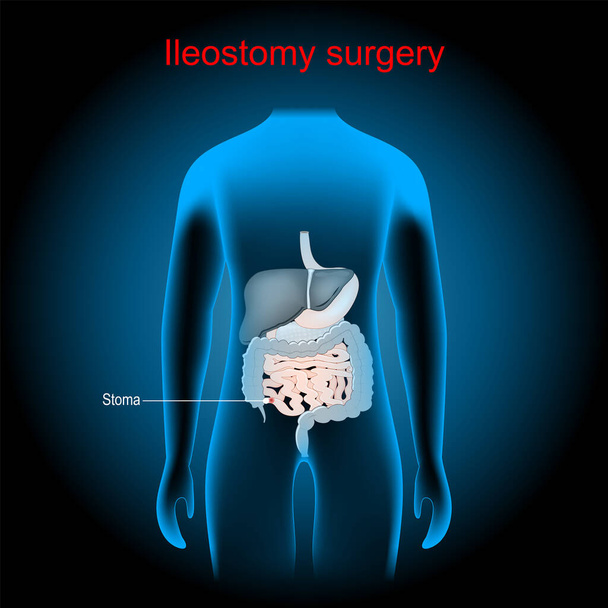 Ileostomy. stoma. surgical opening of small intestine, the ileum out the surface of the skin. surgical procedure. x-ray blue realistic torso with internal organs. Human silhouette on dark background. body anatomy. Vector poster - Vector, Image