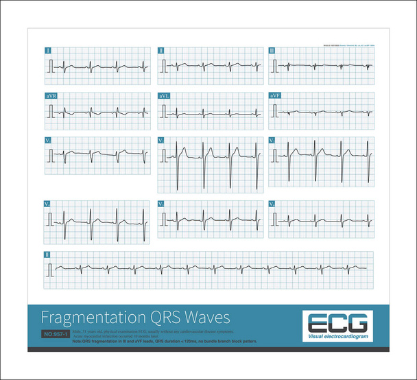 Töredezettség QRS hullám utal a háromfázisú hullám vagy többfázisú QRS hullám, amely egy elektrokardiogram indikátor, amely tükrözi a miokardiális egészség. - Fotó, kép