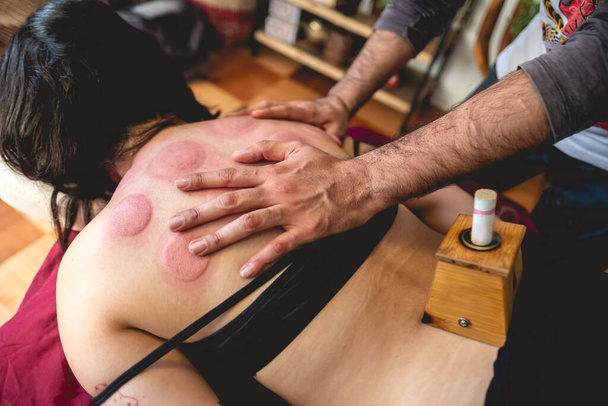 Традиційний китайський лікар з медицини в консультації робить масаж після сеансу для підлітка з синцями і трав'яною моксою палиця в димовому ящику на спині (моксибуляція).)  - Фото, зображення