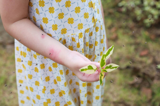 Κοριτσάκι έχει δερματικό εξάνθημα αλλεργία φαγούρα και ξύσιμο στο χέρι της με τα κουνούπια δάγκωμα - Φωτογραφία, εικόνα