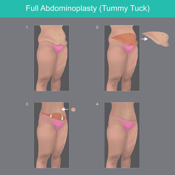 Abdominoplastia completa. Explicar para entender en pasos una cirugía de la grasa del vientre del cuerpo - Vector, Imagen