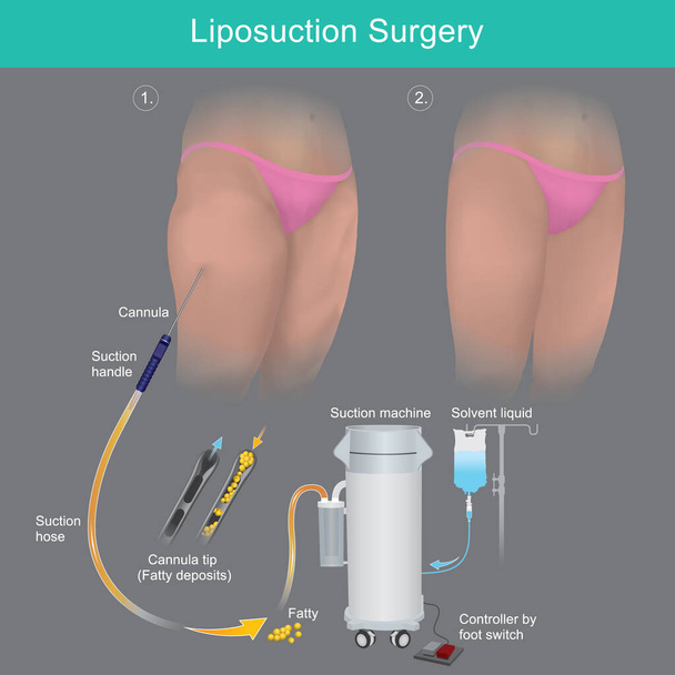 Ліпосакційна хірургія, Поясніть, як реалізувати ліпосакційне лікування в області стегна
 - Вектор, зображення