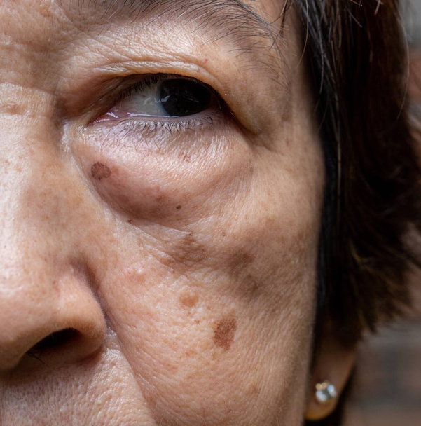 Маленькие коричневые пятна называются возрастными пятнами на лице азиатской пожилой женщины. Их также называют пятнами печени, старческой лентиго или солнечными пятнами. Вид крупным планом. - Фото, изображение
