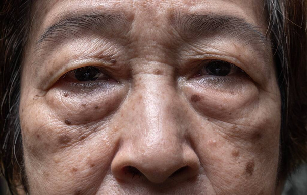 Pequenos manchas marrons chamados pontos de idade no rosto da mulher mais velha asiática. Eles também são chamados de manchas no fígado, lentigo senil ou manchas solares. Vista de perto. - Foto, Imagem