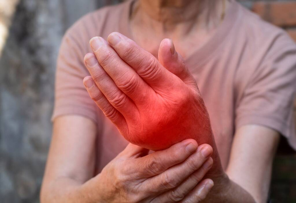 Kézízületek gyulladása. A reumás artritisz, reuma, köszvény, ízületi duzzanat vagy ízületi fájdalom fogalma és fogalma. - Fotó, kép