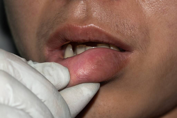 Labios hinchados o engrosados del joven asiático. Angioedema. Las causas pueden ser alergias, infecciones, lesiones, etc.. - Foto, imagen