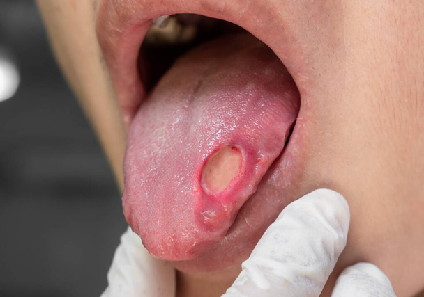 Zweren op de tong van Aziatische mannelijke patiënt. Diagnose kan afteuze zweren, kanker, stress zweren of tong kanker. - Foto, afbeelding