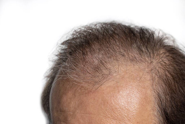 Лиса голова азіатського старшого. Концепція втрати волосся чоловічої статі або розсіяного волосся. - Фото, зображення
