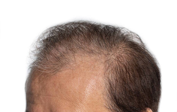 アジア系の老人の頭。男性型脱毛または疎毛の概念. - 写真・画像