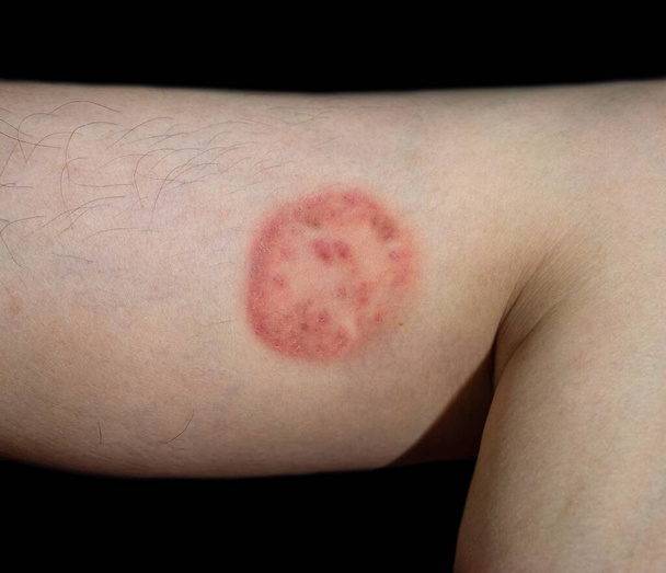 Infección fúngica llamada tinea corporis en el hombre del sudeste asiático. Ringworm. - Foto, Imagen