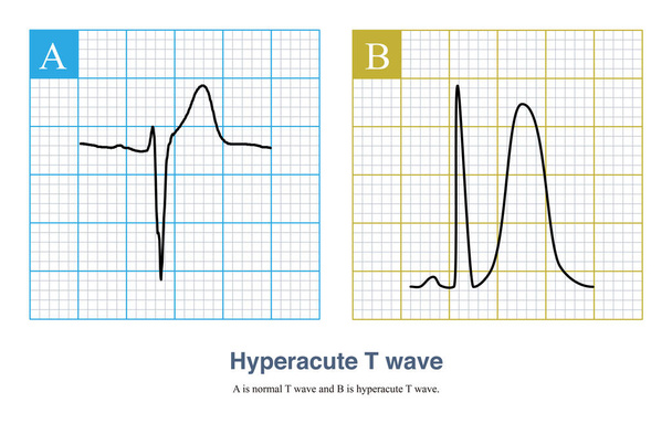 Nos estágios iniciais da isquemia miocárdica aguda, a amplitude da onda T ereta do ECG aumenta, e a simetria da onda T aumenta, chamada onda T hiperaguda.. - Foto, Imagem