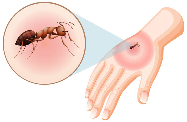 formica morde puntura sulla pelle illustrazione - Vettoriali, immagini