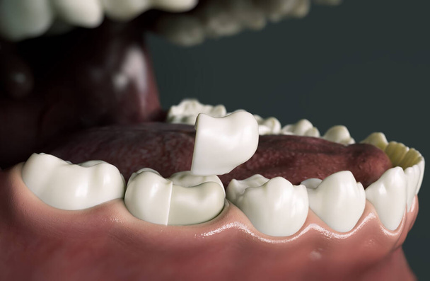 Keramische Onlay-Viertelkrone über einem Zahn -- 3D-Rendering - Foto, Bild