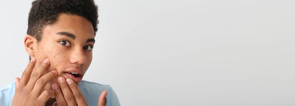 Chico adolescente afroamericano conmocionado con un problema de acné en un fondo claro con espacio para el texto - Foto, imagen