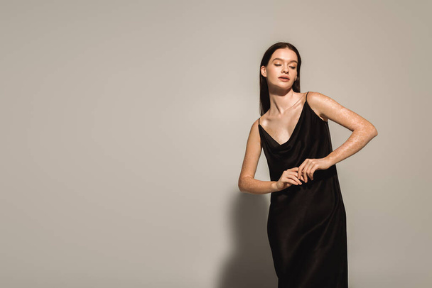Gri arka planda siyah gecelikle poz veren Vitiligo 'lu moda bir kadın.  - Fotoğraf, Görsel