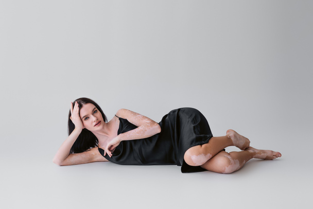 Pretty and barefoot woman with vitiligo lying on grey background  - Fotografie, Obrázek