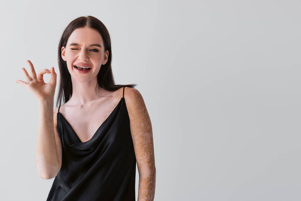 Femme souriante avec vitiligo montrant geste ok et clin d'oeil à la caméra isolée sur gris  - Photo, image