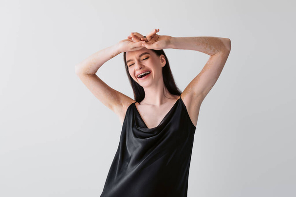 Cheerful woman with vitiligo closing eyes while posing isolated on grey  - 写真・画像