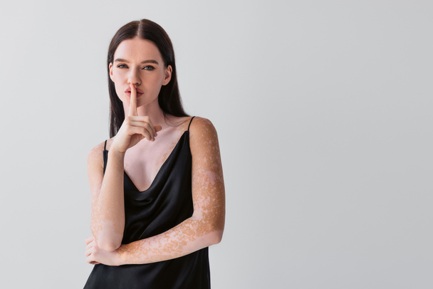 Tyylikäs nuori nainen vitiligo osoittaa salainen ele eristetty harmaa  - Valokuva, kuva