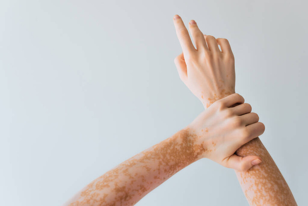 oříznutý pohled na ženu s vitiligo chronickým kožním stavem na rukou izolovaných na šedé  - Fotografie, Obrázek