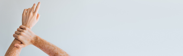 vista ritagliata della donna con vitiligine condizione della pelle cronica sulle mani isolate su grigio, banner - Foto, immagini