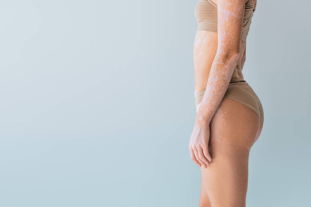 vista recortada de mujer joven con vitiligo de pie en ropa interior aislado en gris - Foto, Imagen