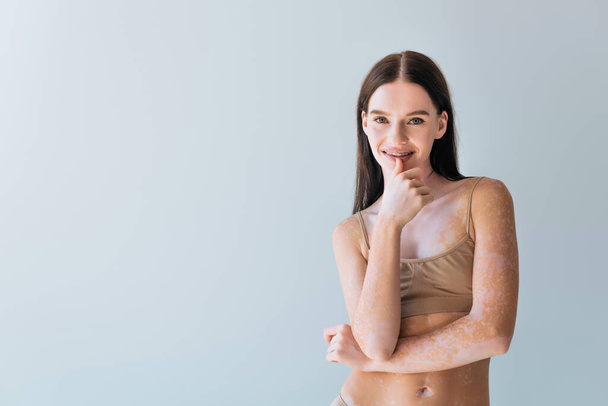 joyful young woman with vitiligo and braces smiling isolated on grey - Zdjęcie, obraz