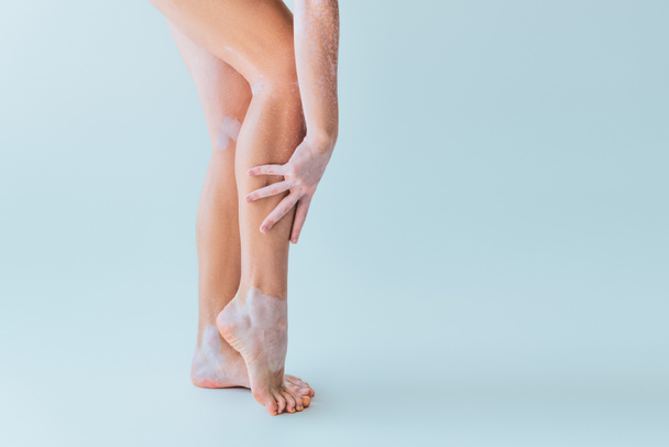 vista parcial de la joven con vitiligo y los pies desnudos de pie sobre fondo gris - Foto, Imagen