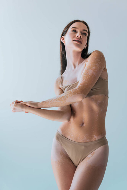 brunette young woman with vitiligo looking away while posing isolated on grey - Foto, Imagem