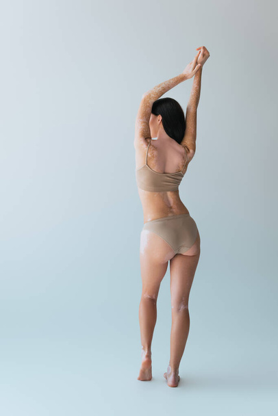 back view of brunette young woman with vitiligo posing in beige lingerie on grey - Foto, Bild
