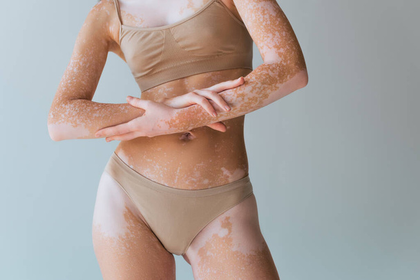 gedeeltelijke weergave van jonge vrouw in lingerie met vitiligo huid staande en poseren geïsoleerd op grijs - Foto, afbeelding