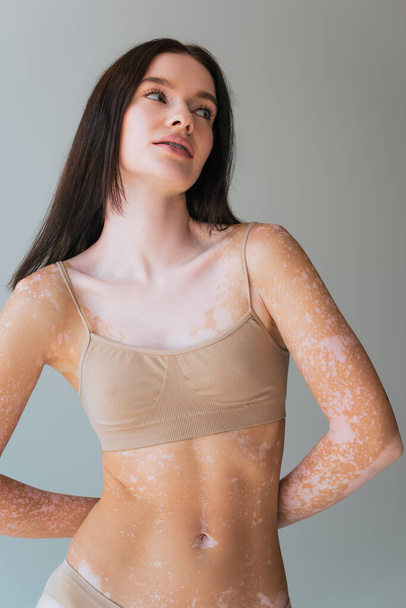 mladá žena s vitiligo stojící v béžové vrchní podprsenka a odvracející se izolované na šedé - Fotografie, Obrázek