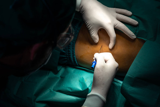 Cirujano inyectar anestesia con jeringa en el paciente antes de realizar la cirugía en quirófano estéril con equipos quirúrgicos modernos. Cirugía médica realizada por cirujano profesional y confiado. - Foto, imagen