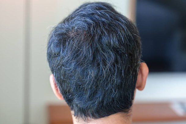 Азиатский мужчина с седыми и седыми волосами растет. Концепция проблемы волос - Фото, изображение
