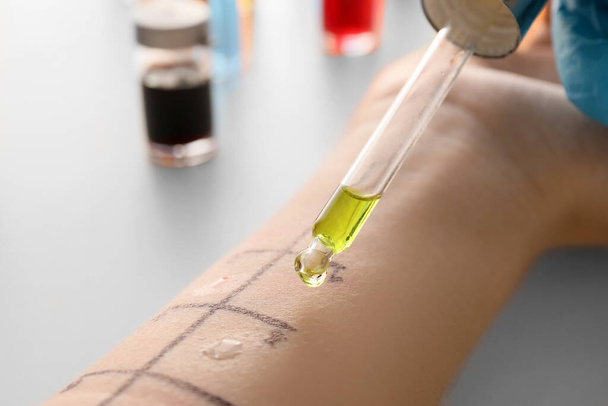 Arzt macht Allergie-Hauttest an der Hand des Patienten in der Klinik, Nahaufnahme - Foto, Bild