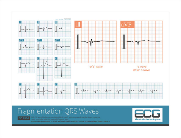 When the left axis deviation, the maximum QRS potential is located in the upper left quadrant, spanning - 30 , and at the negative side of the  lead axis. The QRS main wave in lead II is negative. - Photo, Image