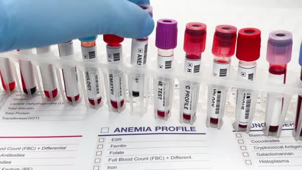 Un campione di sangue prelevato da un paziente per l'analisi dell'anemia. Mano medico in possesso di tubo di prova del sangue per il test di anemia - Filmati, video