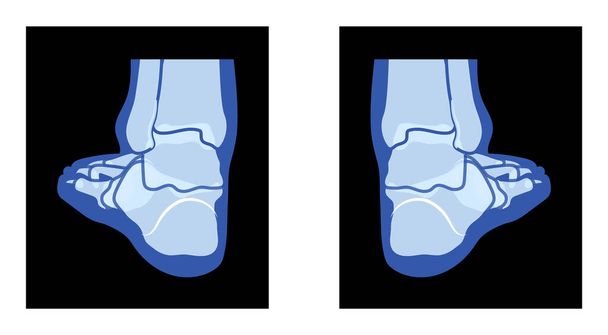 X-Ray Ayak Bacakları İskelet İnsan Vücut Kemikleri - Malleolus, Phalanges Yetişkinler Roentgen Arka Görüşü. Siyah zemin üzerinde izole edilmiş tıbbi anatominin gerçekçi düz mavi renk konsepti Vektör çizimi - Vektör, Görsel