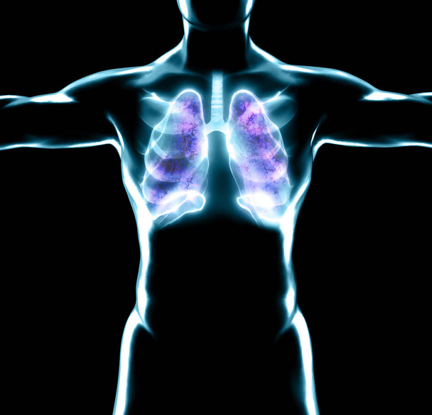 Emberi anatómia, légzési problémák, súlyosan károsodott tüdő. Kétoldali tüdőgyulladás. Covid-19, koronavírus. Beteg és dohányzik. Dohányos. 3D-s renderelés - Fotó, kép
