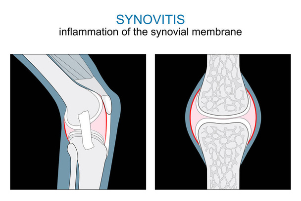 Types of Synovitis. inflammation of the synovial membrane of a Knee and Synovial joint. monochrome flat vector like x-ray illustration.  - Vector, Image