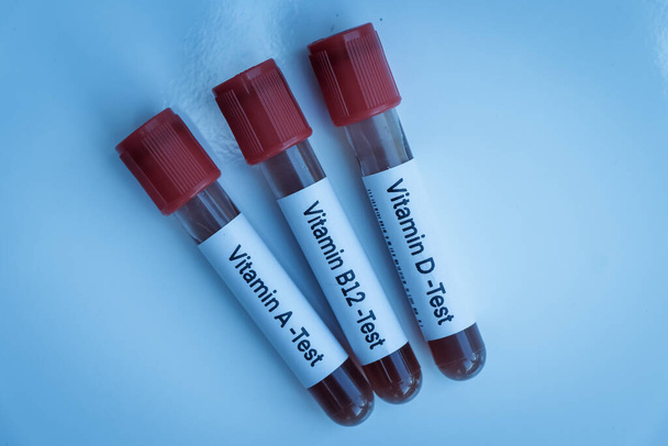 実験室でビタミンをテストするための血液サンプル、試験管での血液サンプル - 写真・画像